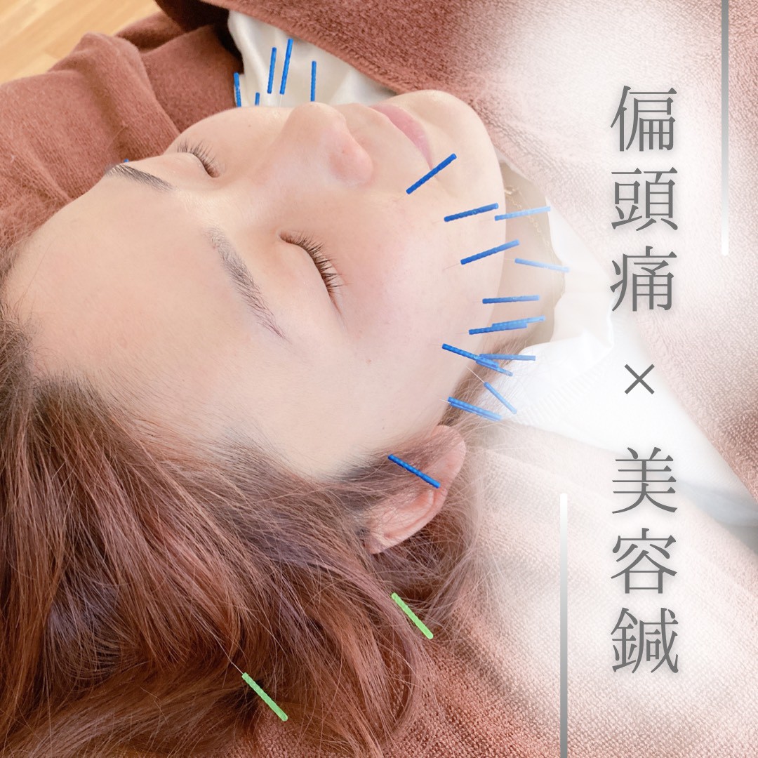 偏頭痛に対しての鍼をしているところ